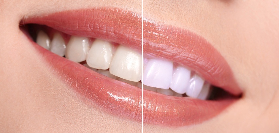 teeth-whitening-beforeafter