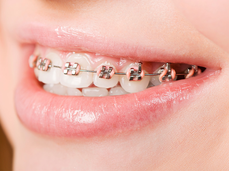 traditional-braces